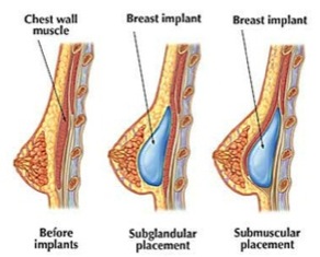 Alila Medical Media, Placement of breast implant for breast augmentation.