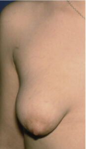 mammella tuberosa
